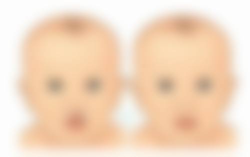 眼袋手术可以做第二次吗？了解手术保持年限及二次手术条件很重要！ 