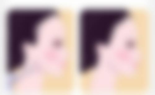 三、做完眼袋手术多久能修复正常：美学与风险提示