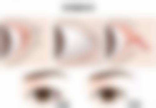 五、做完眼袋手术多久能修复正常：常见疑问解答