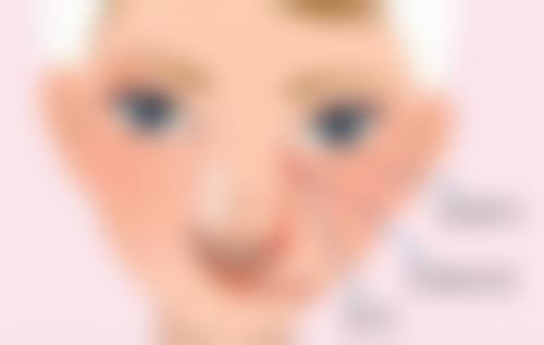 一、埋线双眼皮