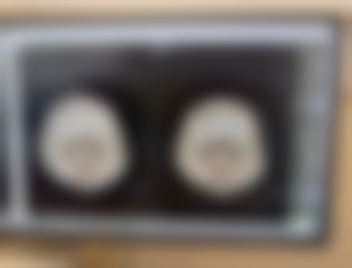 二、眼袋手术可以做第二次吗