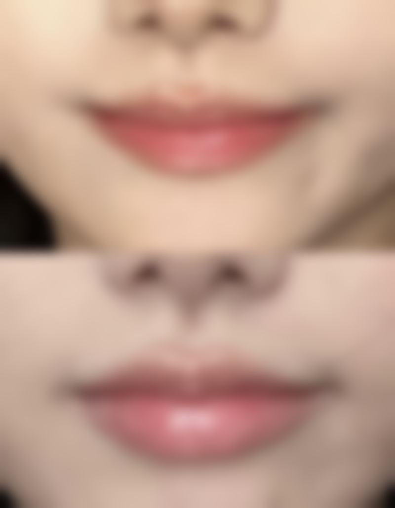 五、如何避免眼袋复发和减少二次手术的需求