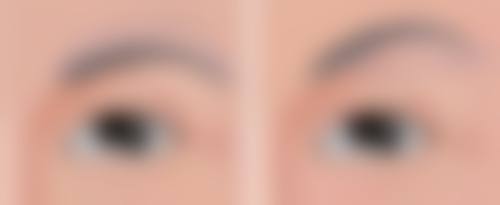 四、什么牌子瘦脸针更好？不同人群的选择建议