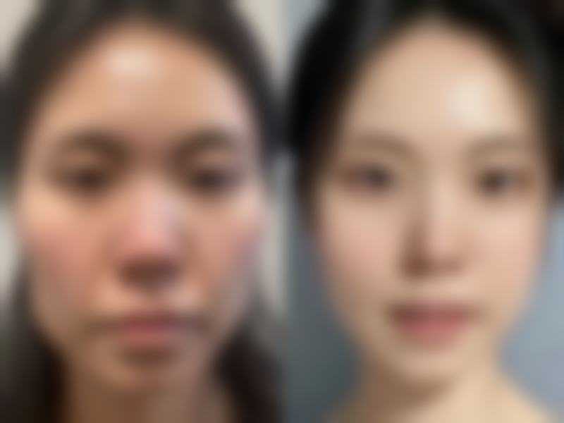 四、怎样快速去掉黑眼圈眼袋之中长期改善方案（2 - 8 周见效）