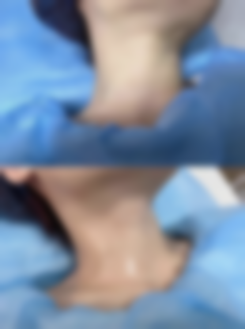 五、如何降低手臂抽脂手术的风险