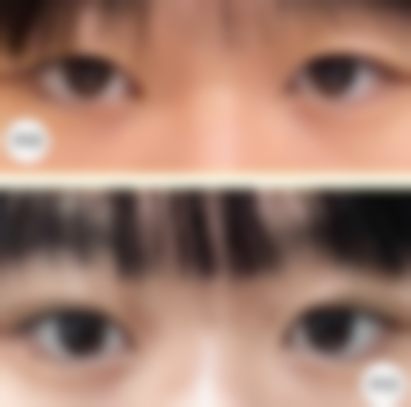 六、怎样快速去掉黑眼圈眼袋之常见误区警示