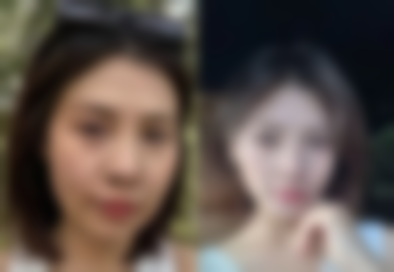 二、卢尚兵修复双眼皮的技术特点与优势