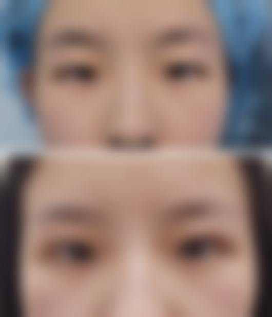 一、大腿吸脂副作用概述