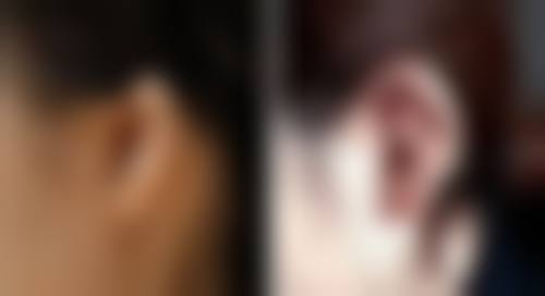 三、打瘦脸针到哪打好——了解注射位置和成效