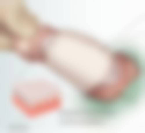 五、假体能否一辈子不取揭秘