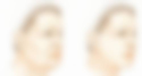 二、冬天做全切双眼皮的潜在优势