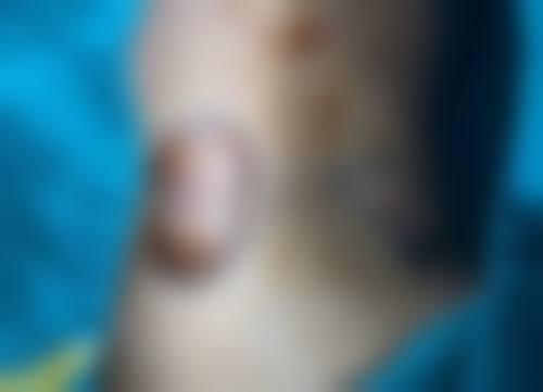 法令纹和眼袋怎么解决？多维度方案助你消除烦恼重拾年轻肌肤