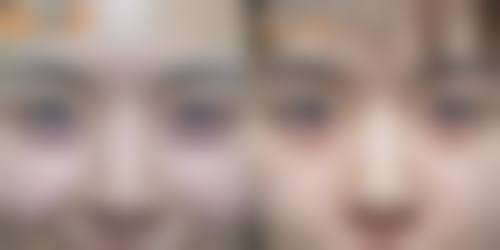 四、头发种植成效的实例分析