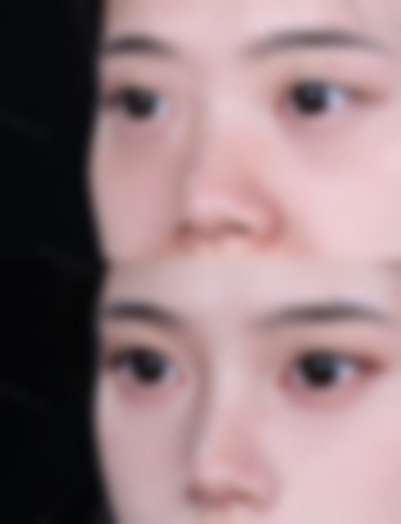 七、法令纹和眼袋怎么解决：总结与提醒