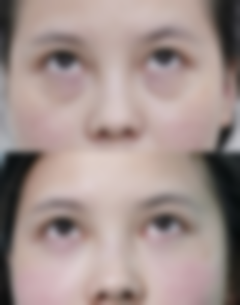 头发种植的永久吗？揭秘头发种植能保持多久时间及影响持久效果的因素