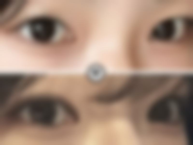 三、自体脂肪隆胸的危害和后遗症