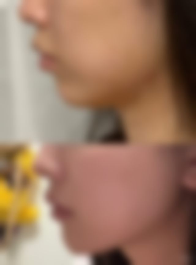 隆鼻可吸收线多久吸收？了解不同线材吸收时间及影响因素，助你选好隆鼻方案 