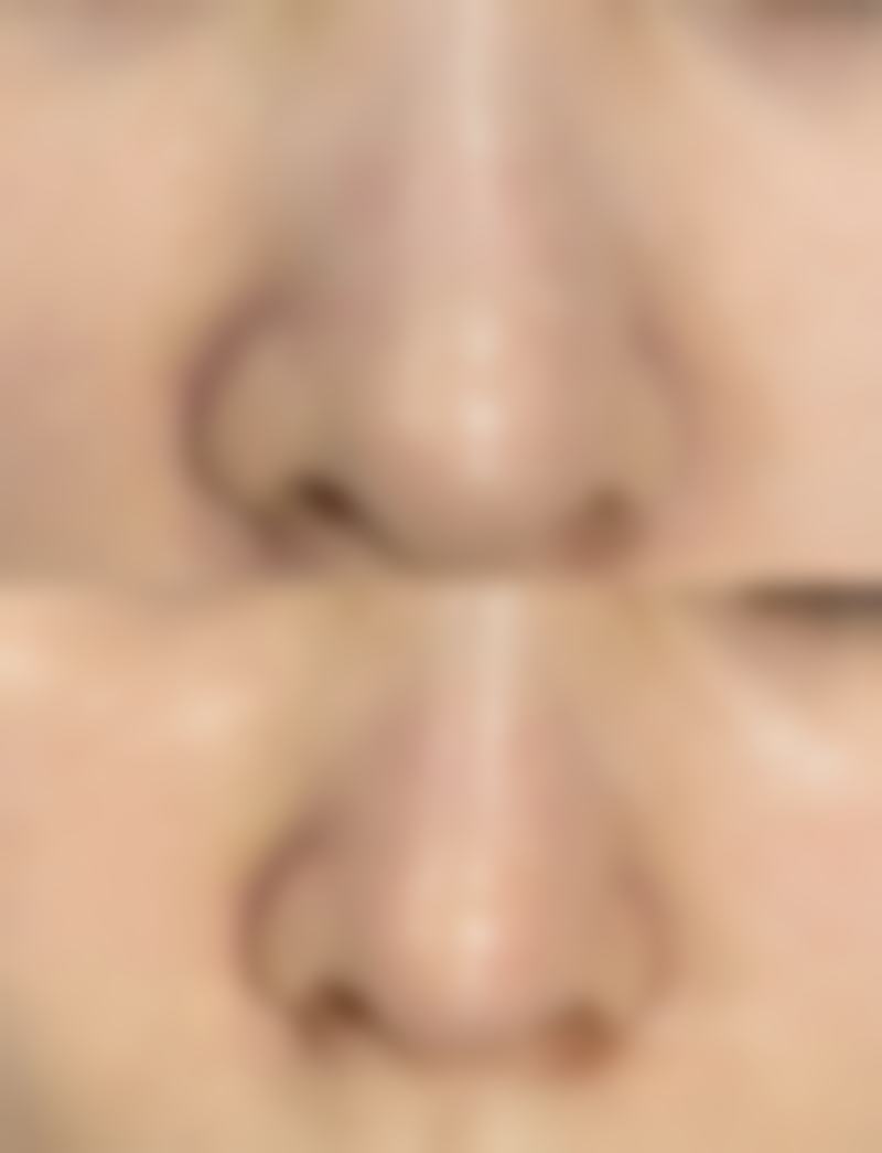 种植头发怎么做的？全程步骤大揭秘，同时了解种植头发的危害和后遗症！ 