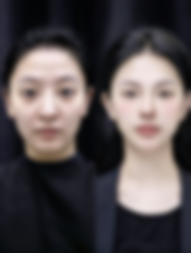 五、假体是否需一辈子取出