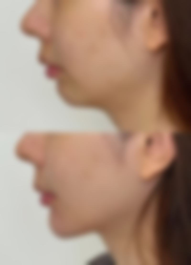 一、硅胶隆鼻和膨体的基本介绍