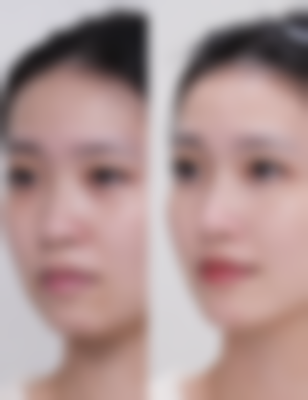 二、全切双眼皮修复阶段的具体表现和护理重点