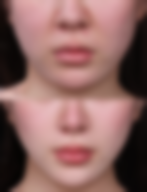 二、怎样可以祛掉黑眼圈眼袋之主流解决方案对比