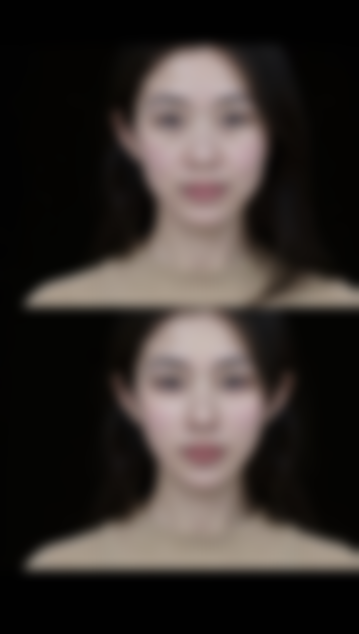 一、瘦脸针药效的常规时长