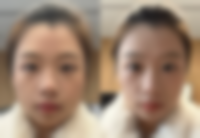 全切双眼皮多久能消肿退红？恢复时间、阶段及护理建议全揭秘！ 