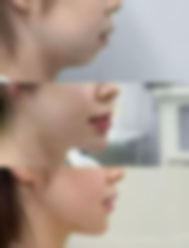 二、眼袋贴的原理与局限性