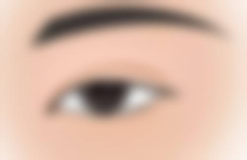 一、内脏脂肪吸脂的真相