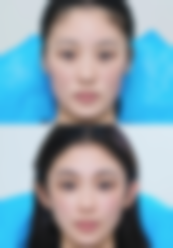 一、怎样做双眼皮更自然之选对手术方式