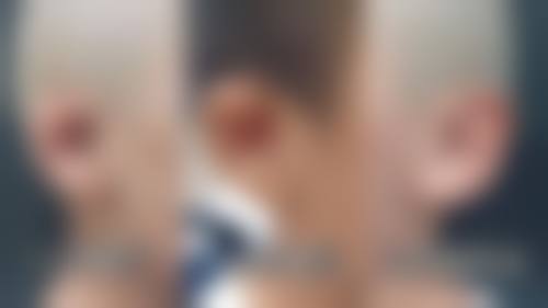 二、全切双眼皮术后不同阶段的化妆建议