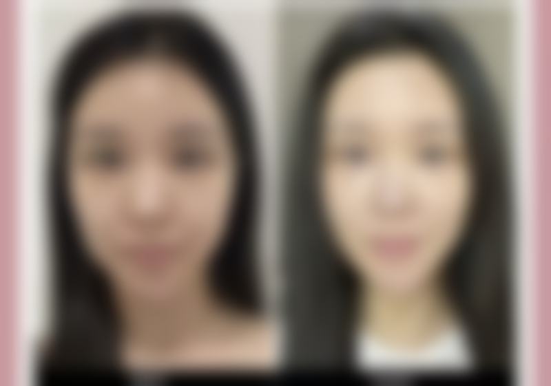 三、影响手臂吸脂修复速度的因素