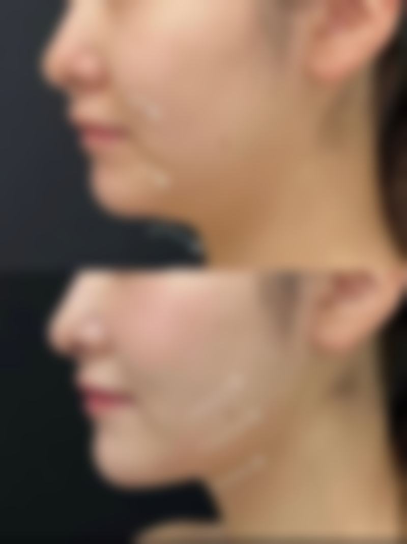 有什么方法可以让眼袋消失呢？非手术与手术方式全揭秘，助你重焕眼部光彩 