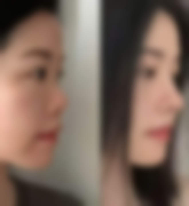 打完瘦脸针多久可以见效果？多久效果最明显？全面解答让你心中有数！ 