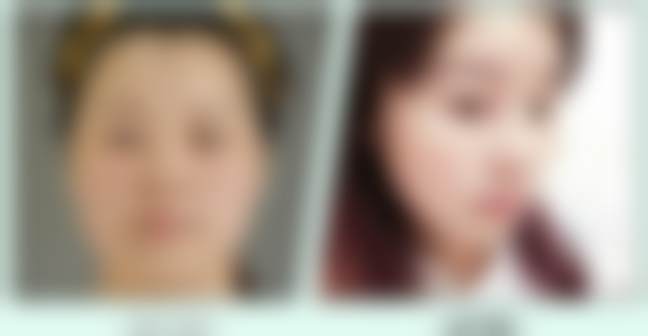 二、北京禾美嘉医生在五代热玛吉眼部450发项目的优势