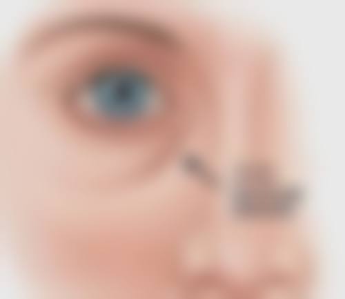 三、割双眼皮后眼皮外翻的具体修复方式