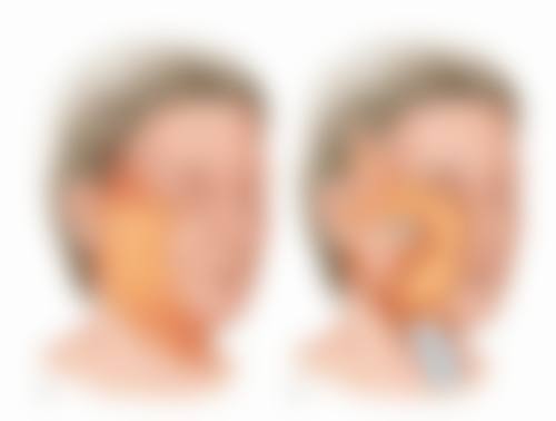 三、割双眼皮无论季节都要做好的三点