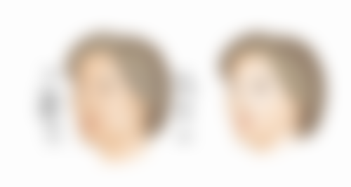 五、消除眼袋后的护理和注意事项