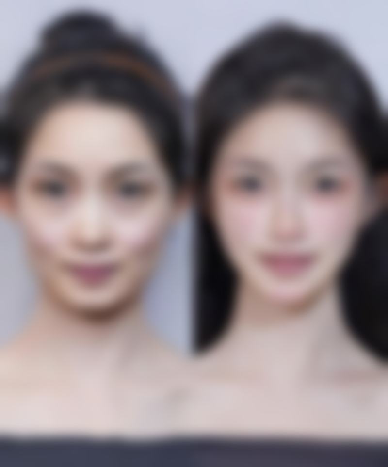 一、夏天割双眼皮的优劣势与注意事项