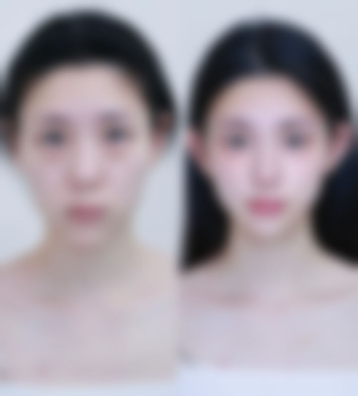 四、怎样去眼袋和皱纹：手术矫正方法