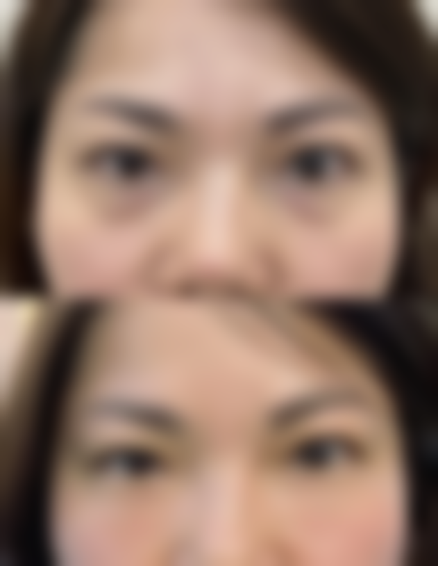 五、怎样去眼袋和皱纹：注意事项