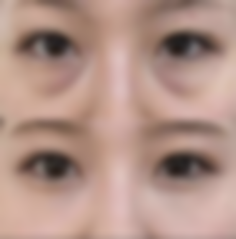 二、冬天割双眼皮的优劣势与注意事项