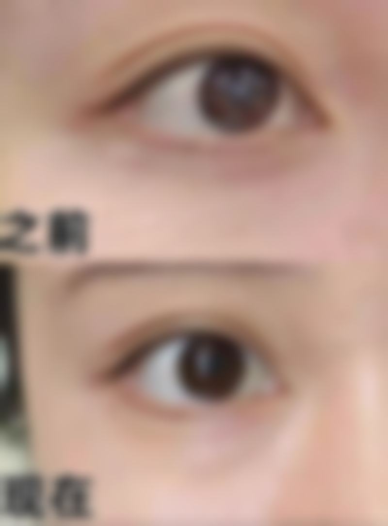 割双眼皮后眼皮外翻怎么修复好？多种方法助你有效改善恢复眼部美观