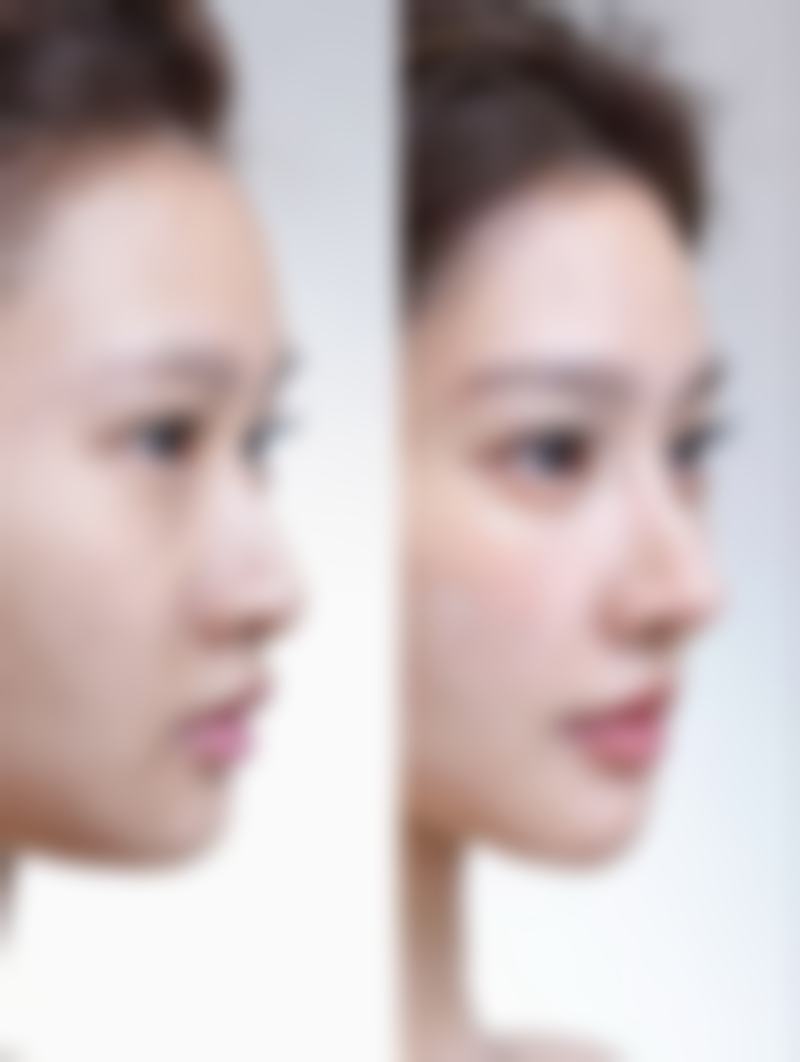 双眼皮和眼袋能同时做吗？了解联合手术可行性与恢复期关键要点 