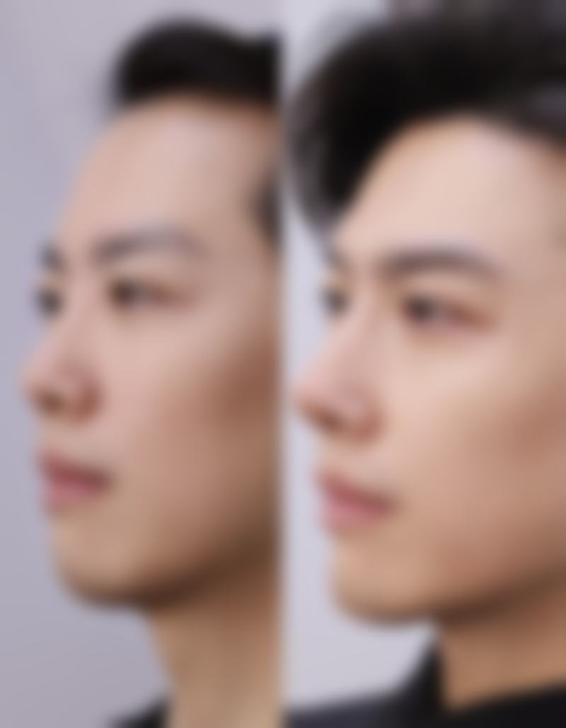 埋线双眼皮还能恢复到原来样子吗？术后时间、个体差异等因素影响恢复情况 