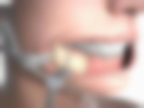 拆线后双眼皮会变窄吗？了解变窄原因、程度及恢复阶段特点，附变窄前后对比图片 