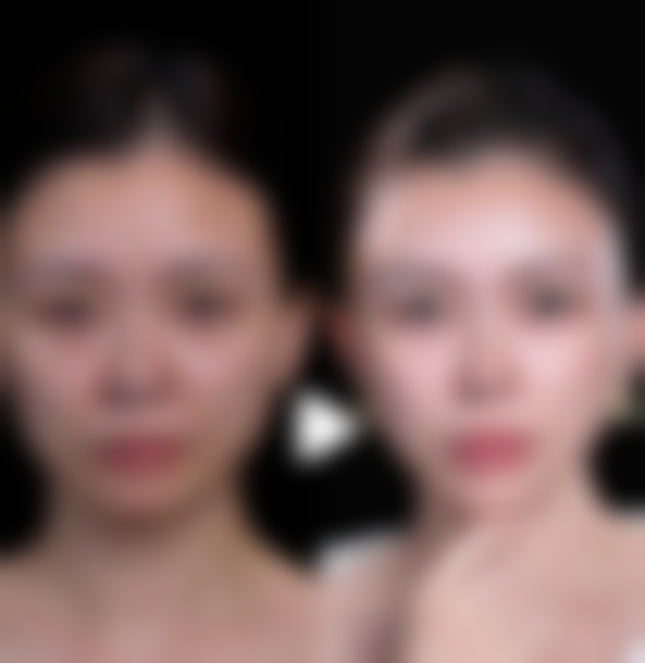 一、瘦脸针多久看得出成效之显效时间