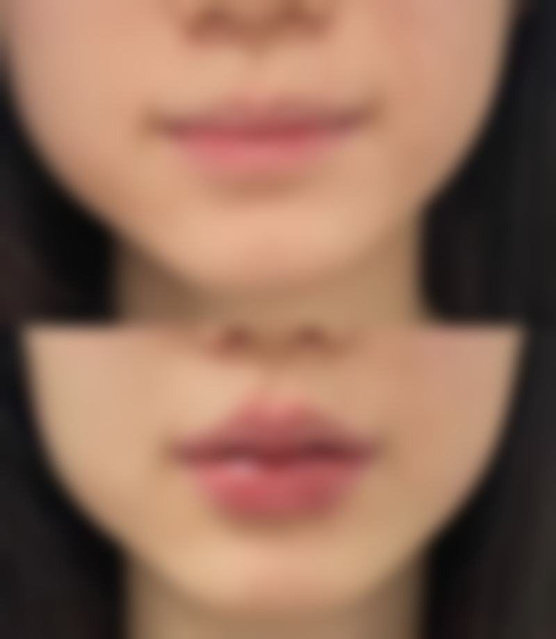 双眼皮可以做成内双吗？揭秘手术方法、效果维持及术后恢复的关键要点 