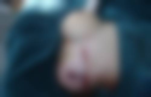 四、疤痕美学改善小贴士